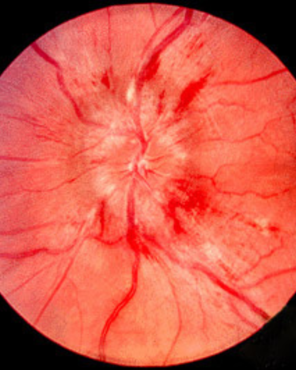 набряк зорового нерва, папіліт, неврит зорового нерва